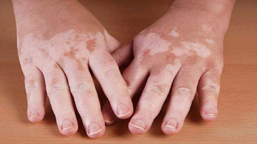 Bệnh bạch biến là tình trạng da bị mất màu theo từng mảng, thường gặp ở bàn tay, mặt, nách