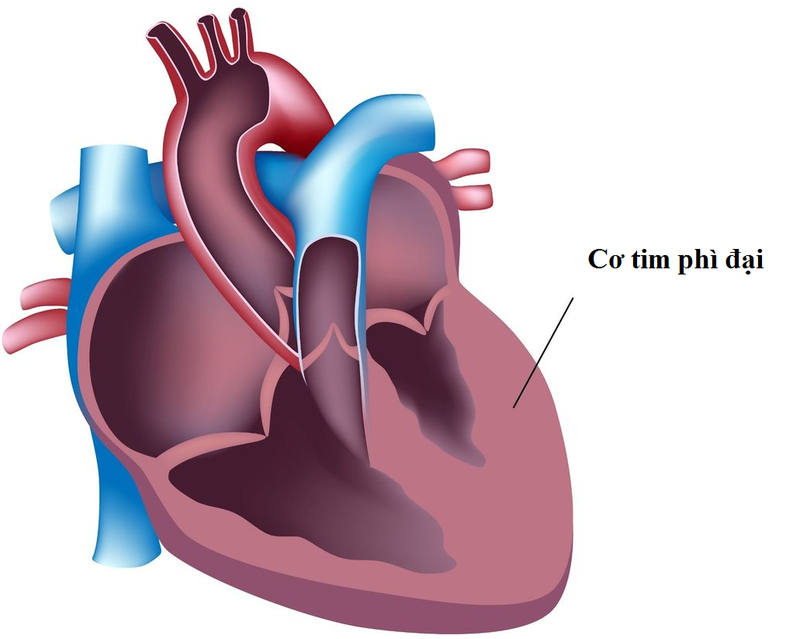 Bệnh cơ tim là tình trạng cấu trúc tim bị biến dạng