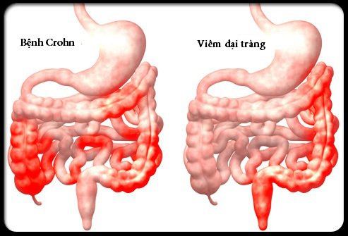 Nguyên nhân Bệnh Crohn