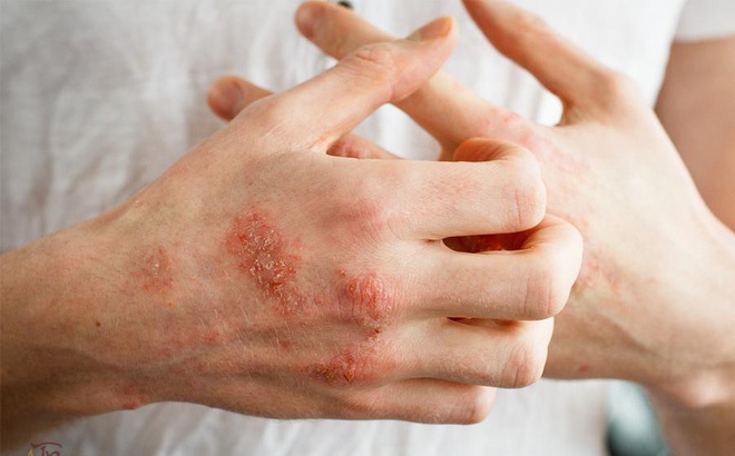 Bệnh ghẻ là bệnh ngoài da gây nên bởi loại rệp nhỏ