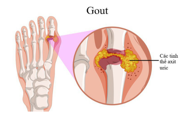Người lớn tuổi, nam giới là đối tượng có nguy cơ cao mắc bệnh gout