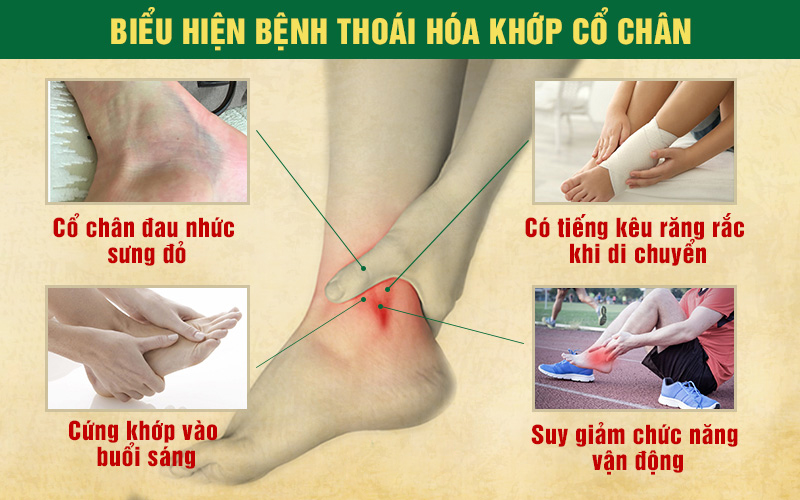 Biểu hiện của bệnh thoái hoá khớp cổ chân