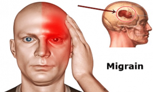 Đau nửa đầu Migraine