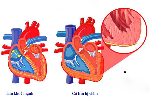 Viêm cơ tim chưa có thuốc điều trị đặc hiệu mà chỉ có thể can thiệp điều trị triệu chứng