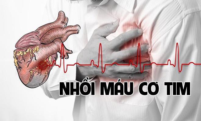 Nhồi máu cơ tim là tình trạng tắc mạch xảy ra ở động mạch vành.