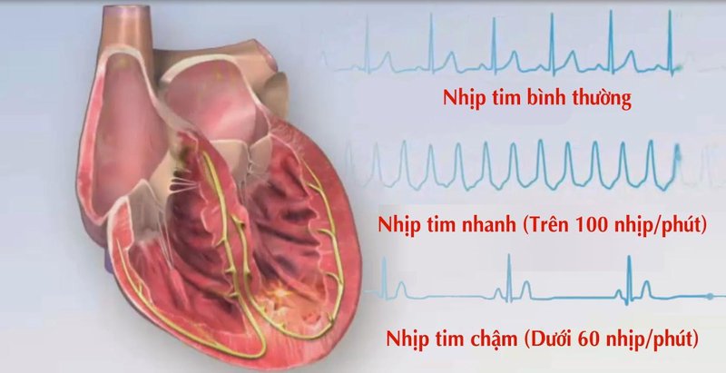 Rối loạn nhịp tim là tình trạng nhịp tim bất thường quá nhanh hoặc quá chậm