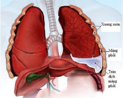 Nguyên nhân tràn dịch màng phổi