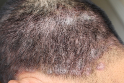 Triệu chứng bệnh nấm da đầu