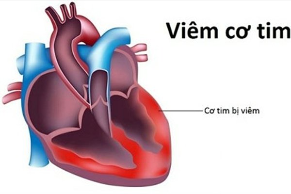 Viêm cơ tim chủ yếu do nhiễm vi khuẩn, nấm