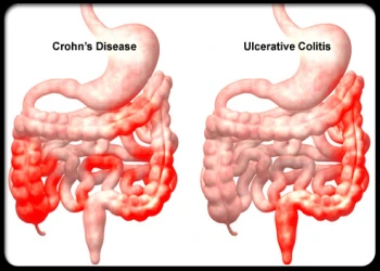 Bệnh Crohn là gì và những dấu hiệu nhận biết bệnh Crohn