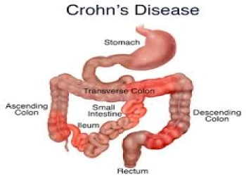 5 sai lầm bệnh nhân bị bệnh Crohn rất dễ mắc phải