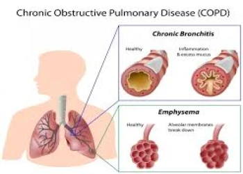 Các thuốc mới điều trị bệnh phổi tắc nghẽn mãn tính - COPD hiện nay