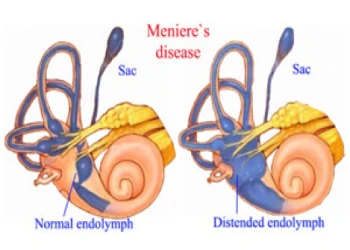 Triệu chứng và dấu hiệu bạn mắc bệnh Meniere 